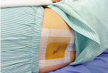 从“制造”到“智造”医疗电路板smt加工之路